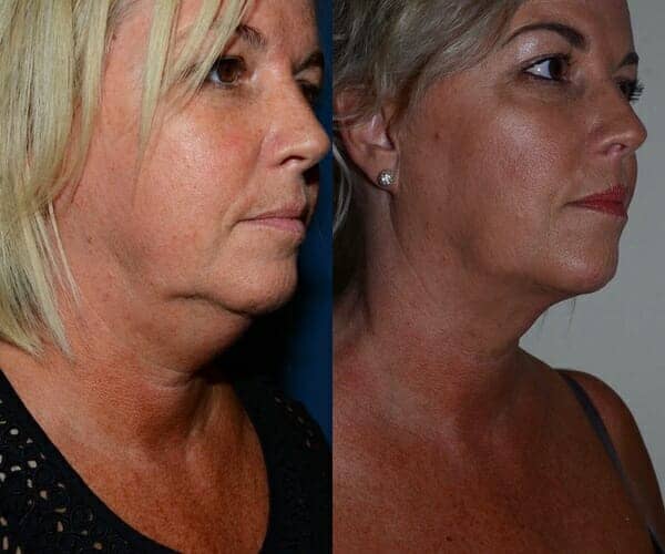 Neck liposuction