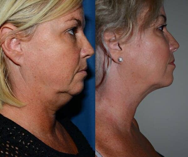 neck liposuction neck lift Scotland