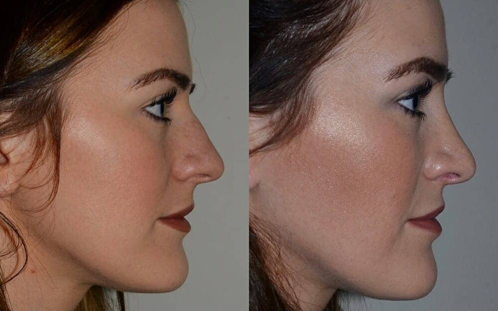 Rhinoplasty to correct bump and septal deviation