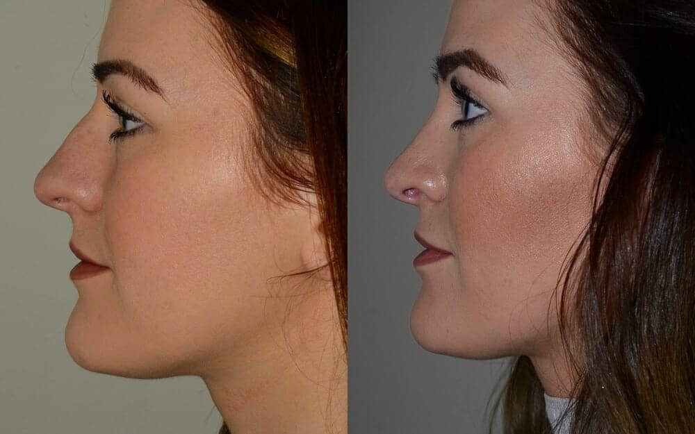 Rhinoplasty to correct bump and septal deviation