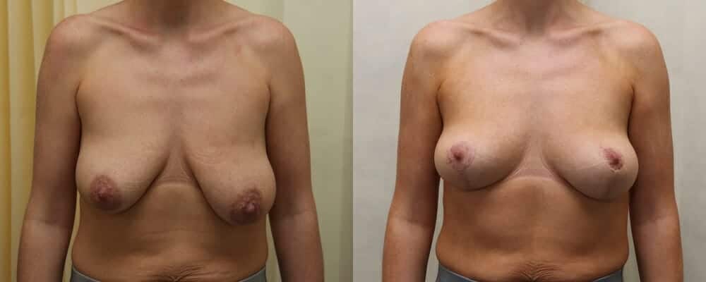 Breast lift plus immediate fat transfer