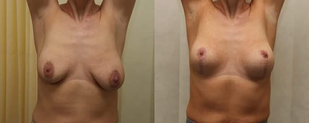 Breast lift plus immediate fat transfer