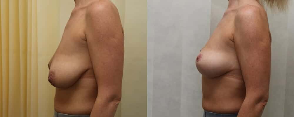 Breast lift plus immediate fat transfer