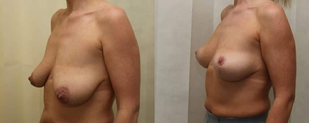 Breast lift plus immediate fat transfer