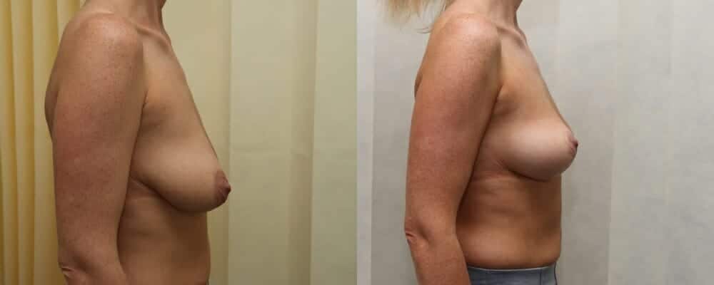 Breast lift plus immediate fat transfer