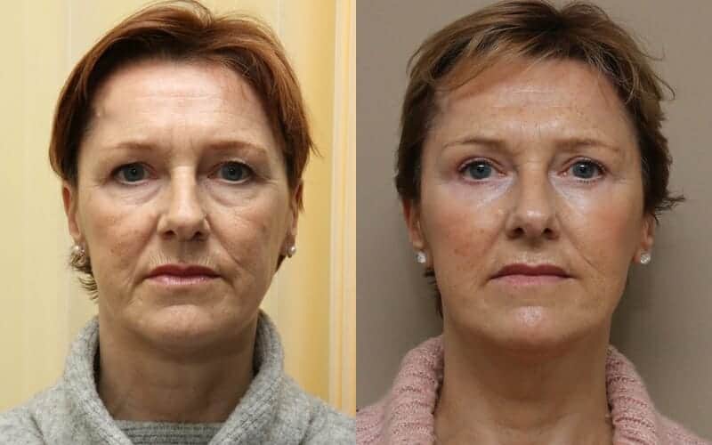 Upper and lower eyelid surgery