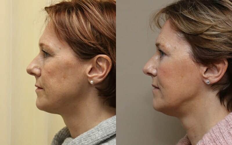 Lower face/ neck lift and eyelid surgery