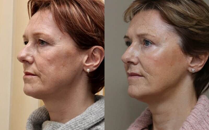 Upper and lower eyelid surgery