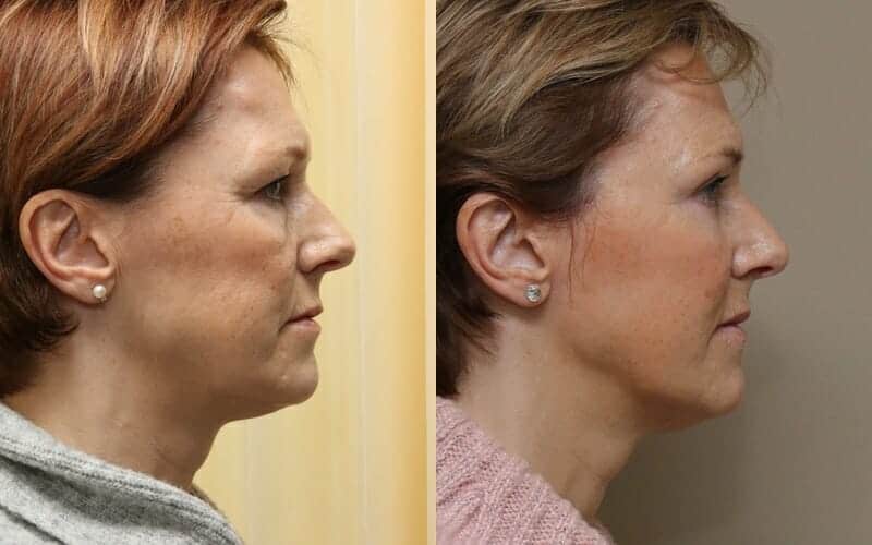 Lower face/ neck lift and eyelid surgery