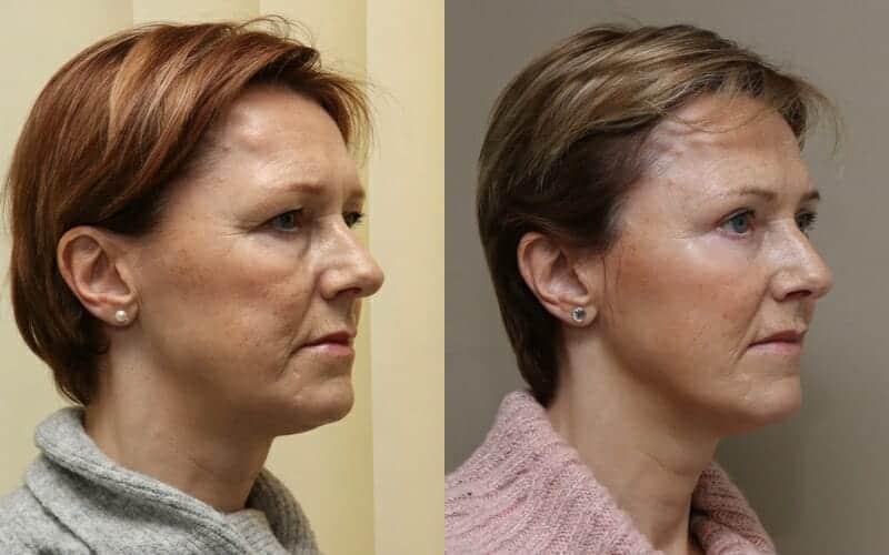 Lower face/ neck lift and eyelid surgery