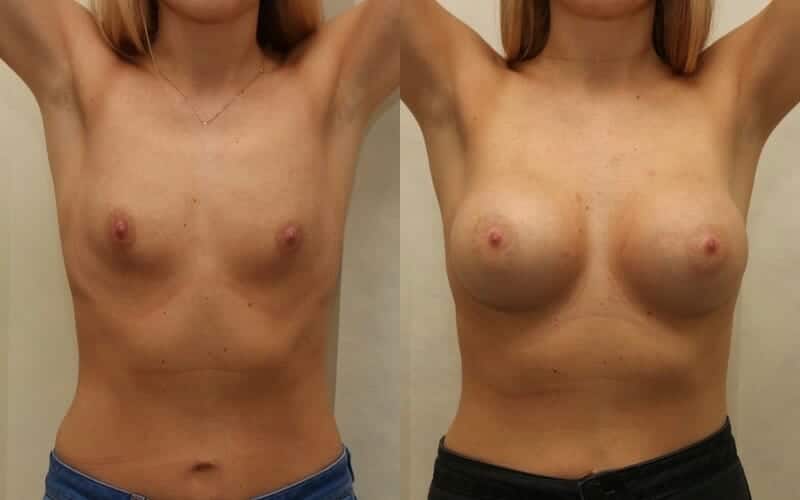 32A to 32D dual plane breast implants