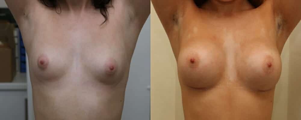 Breast implants over the muscle