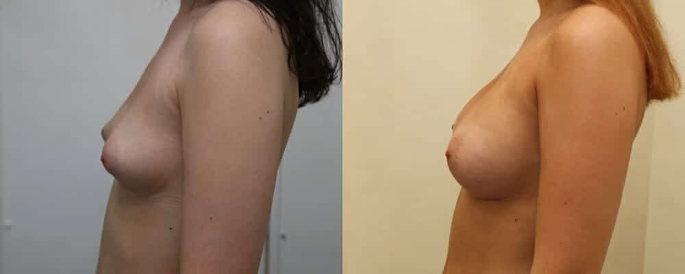 Breast implants over the muscle