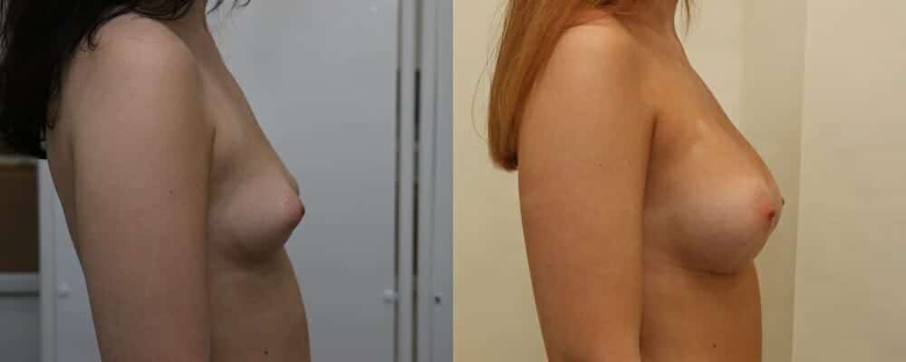 Breast implants over the muscle