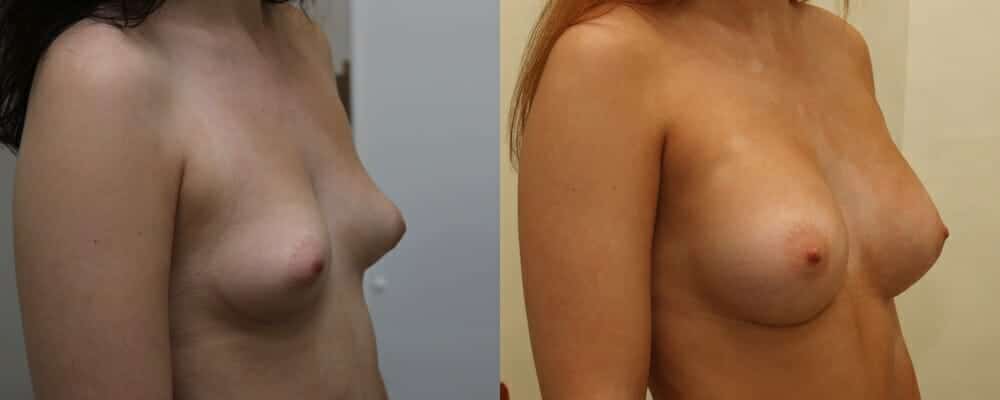 Breast implants over the muscle