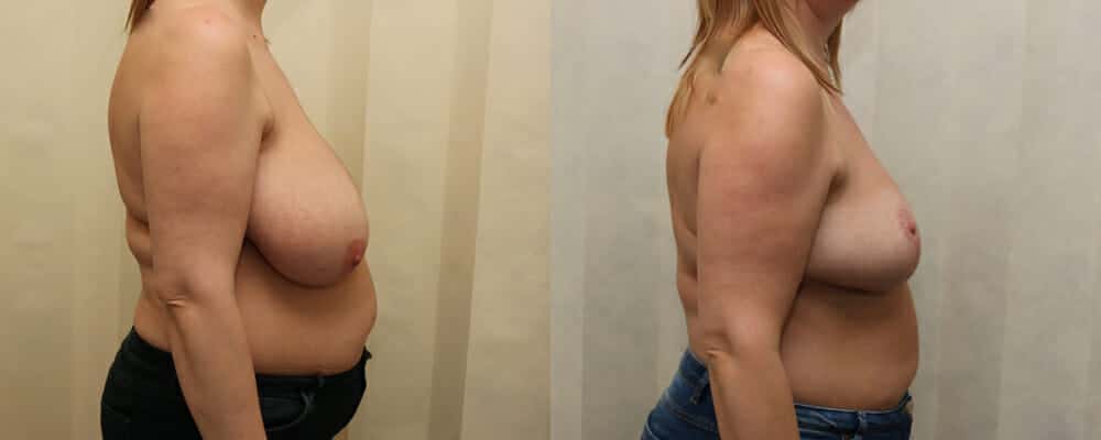 Breast reduction