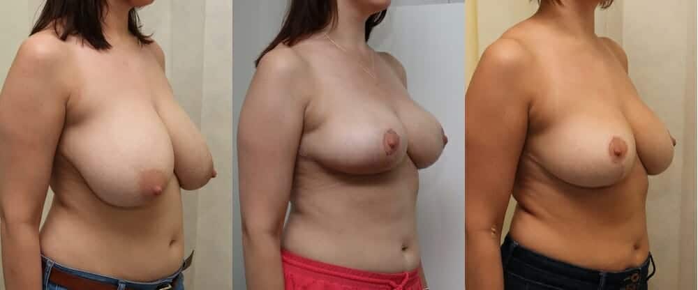 Breast reduction 4 weeks and 6 months