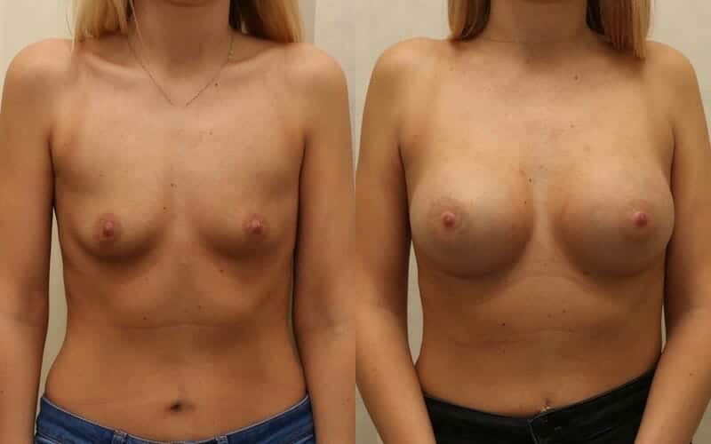 32A to 32D dual plane breast implants