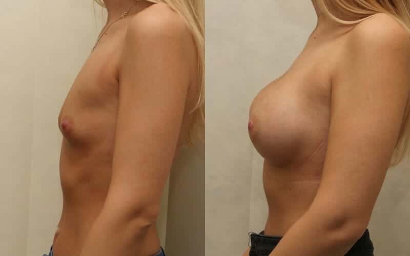 32A to 32D dual plane breast implants