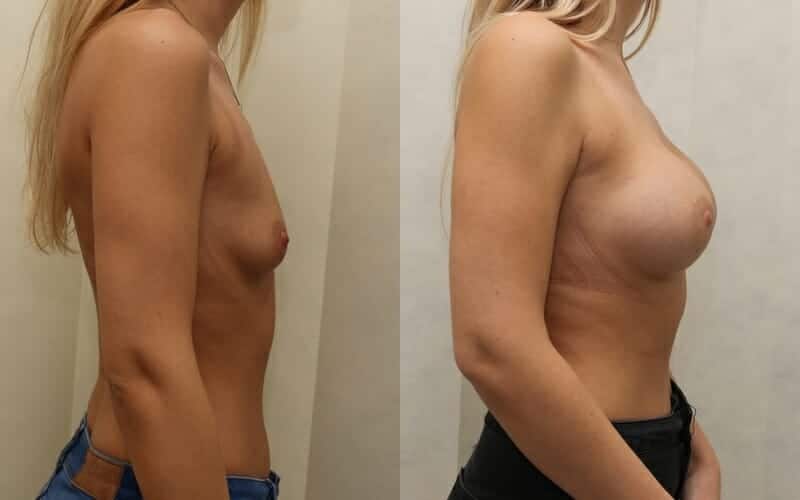 32A to 32D dual plane breast implants