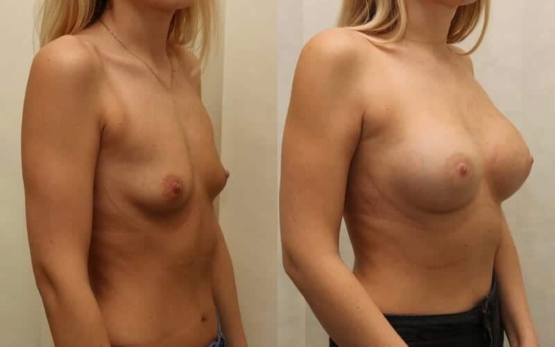 32A to 32D dual plane breast implants