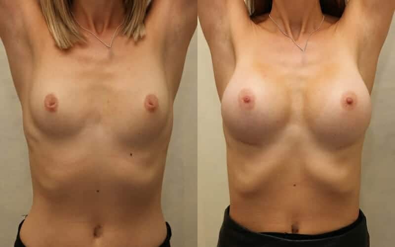 Dual plane augmentation and correction of inverted nipples