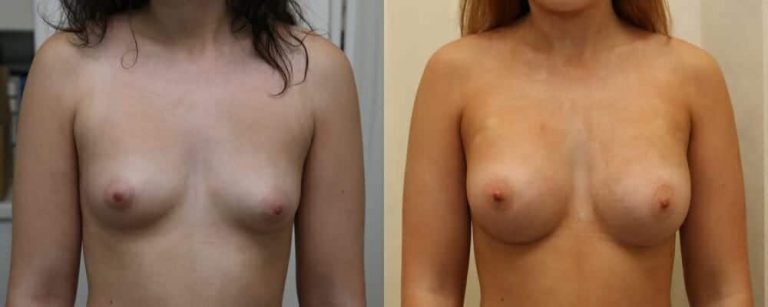 Breast augmentation subglandular before and after, photo 1 of 6