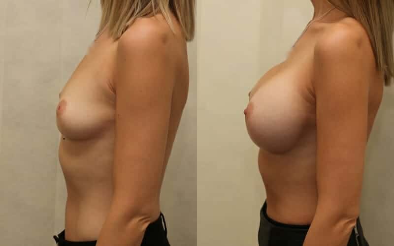 Dual plane augmentation and correction of inverted nipples