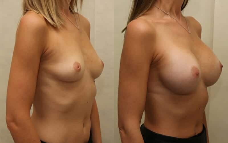 Dual plane augmentation and correction of inverted nipples