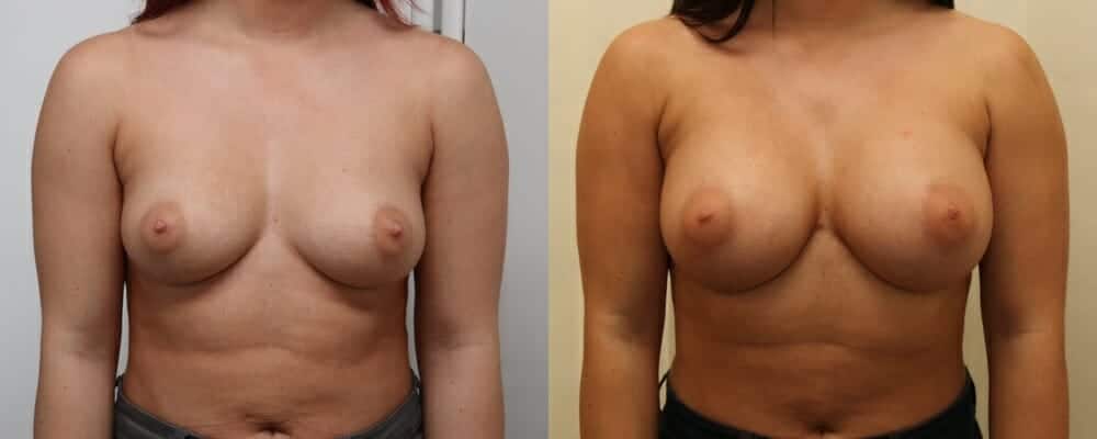 Breast augmentation C to E cup