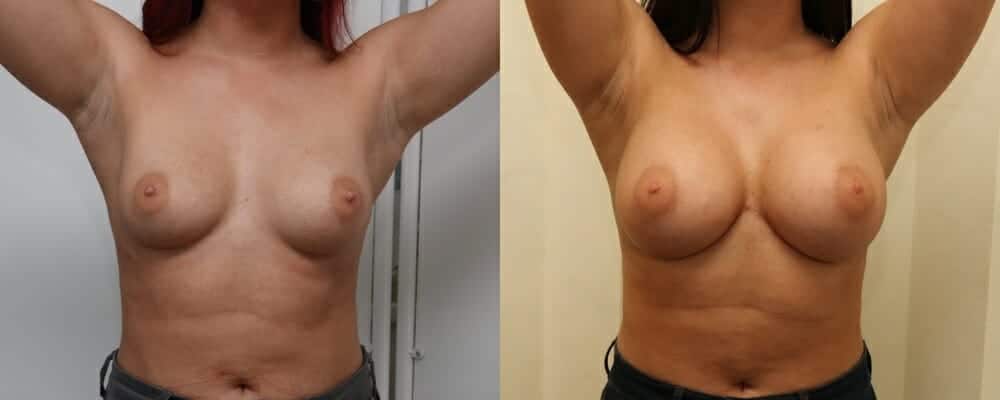 Breast augmentation C to E cup