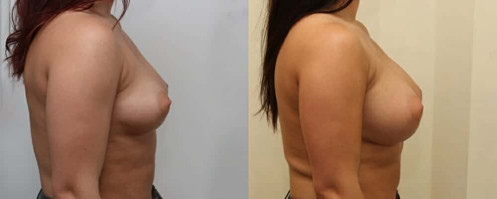 Breast augmentation C to E cup