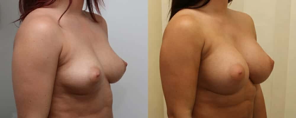 Breast augmentation C to E cup