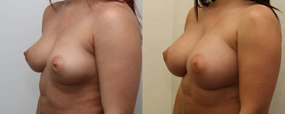 Breast augmentation C to E cup