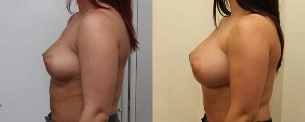 Breast augmentation C to E cup