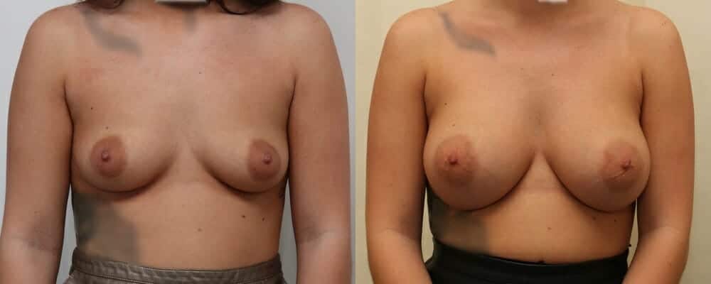 Breast augmentation B to D cup