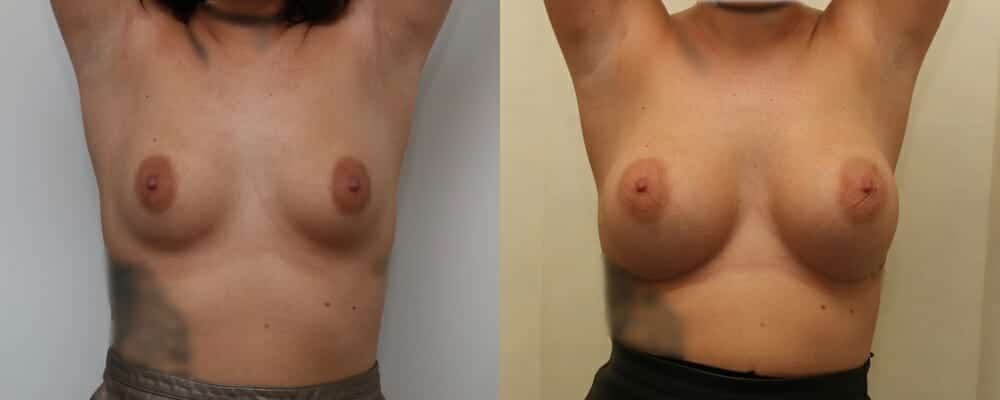 Breast augmentation B to D cup