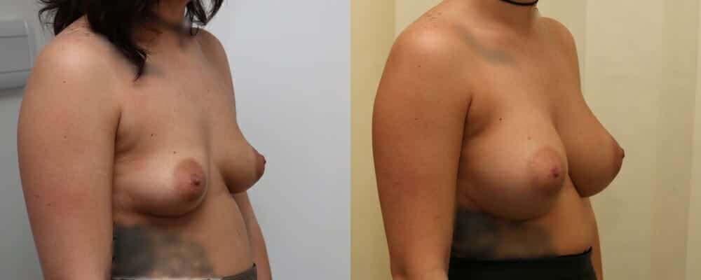 Breast augmentation B to D cup