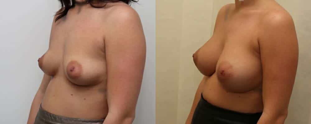 Breast augmentation B to D cup