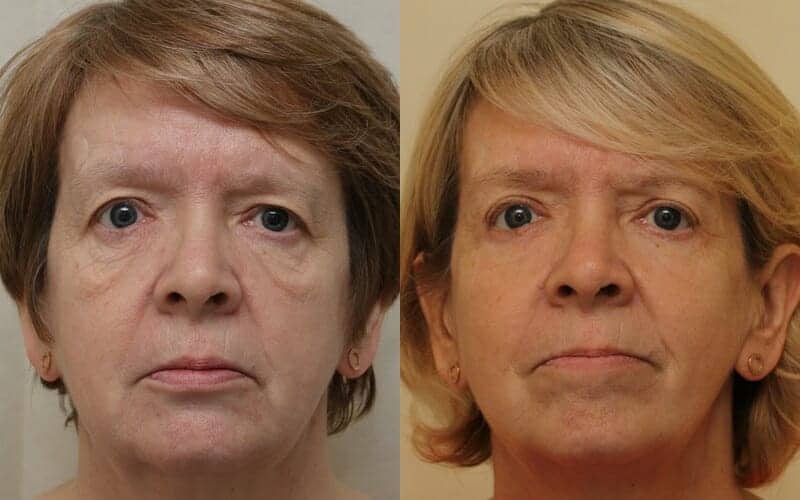 Upper and lower eyelid surgery