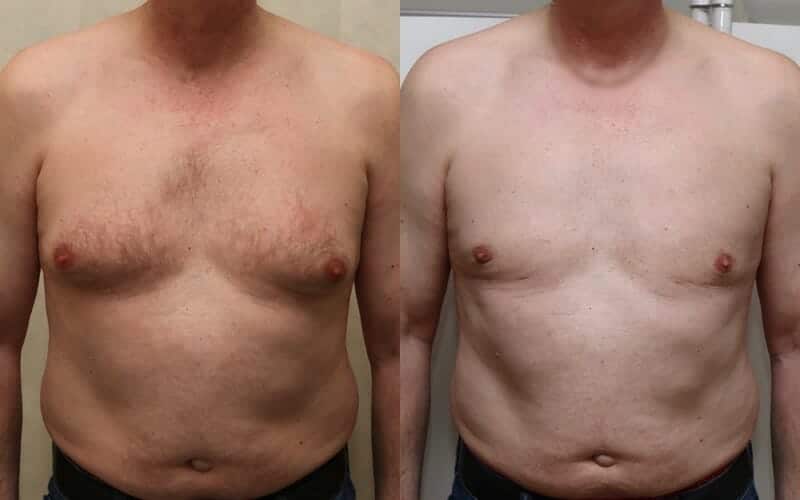 Male breast reduction