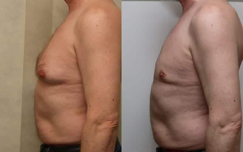 Male breast reduction