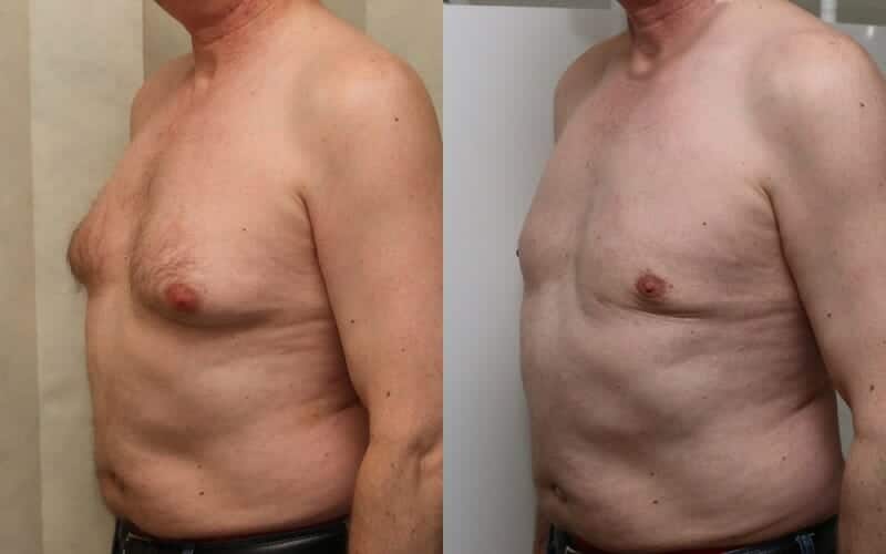 Male breast reduction