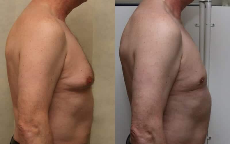 Male breast reduction