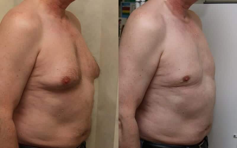 Male breast reduction