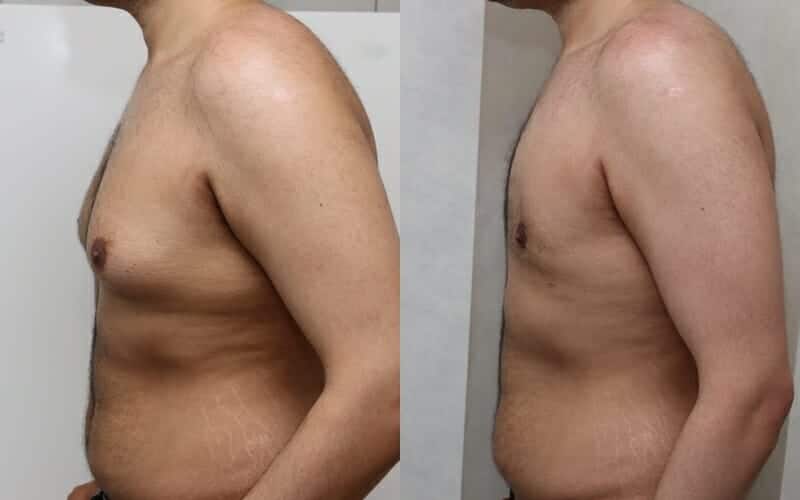 Male breast reduction before and after
