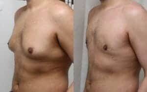 Male breast reduction Edinburgh Scotland