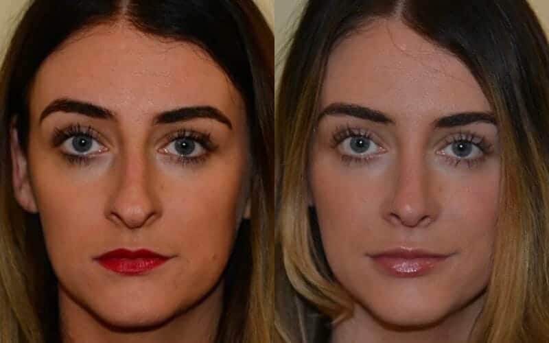 Dorsal hump reduction and tip refinement