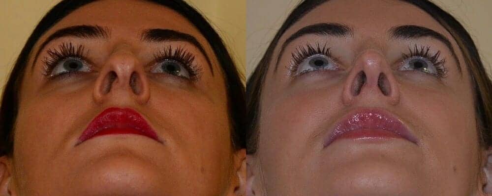 Dorsal hump reduction and tip refinement