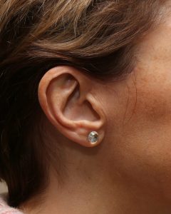facelift scars Scotland